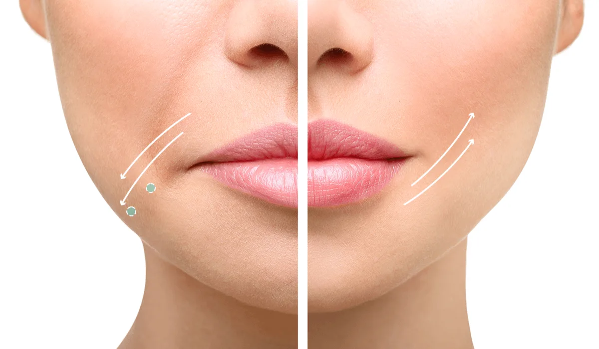 입꼬리올림보톡스 - 미모드림의원