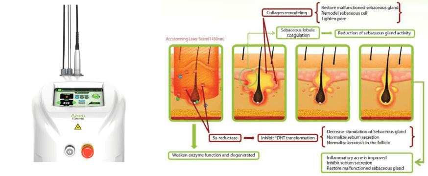 [크기변환]노세범레이저(아큐토닝)1