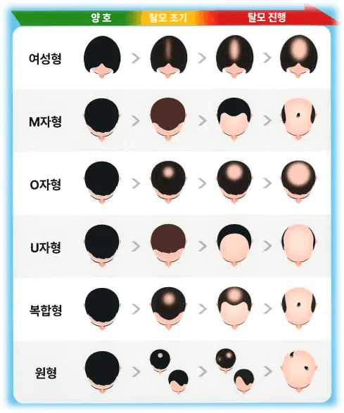 탈모 유형 표1 탈모 유형 표1
