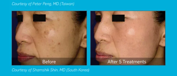 [크기변환]피코슈어8-2