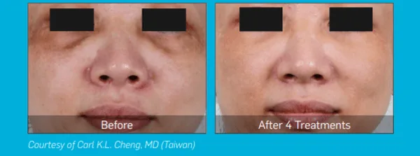 [크기변환]피코슈어9-1