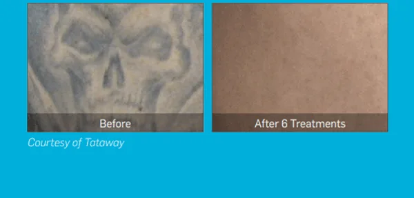 [크기변환]피코슈어9-3