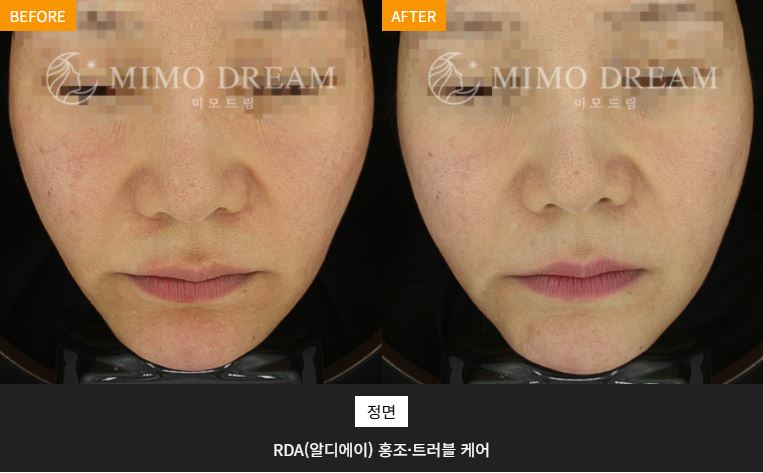 RDA 홍조트러블 케어 3