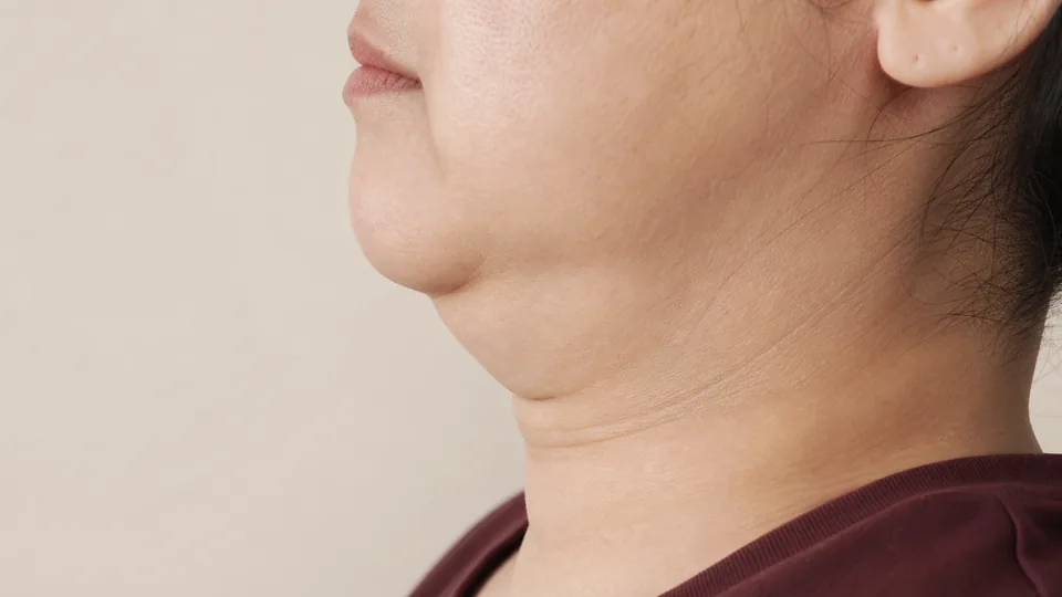 턱을 들어도 접히는 이중턱 — 고민 카드