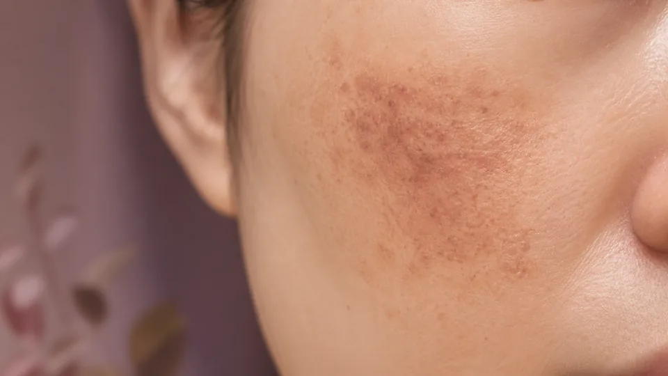 거뭇하게 남은 색소침착 — 고민 카드