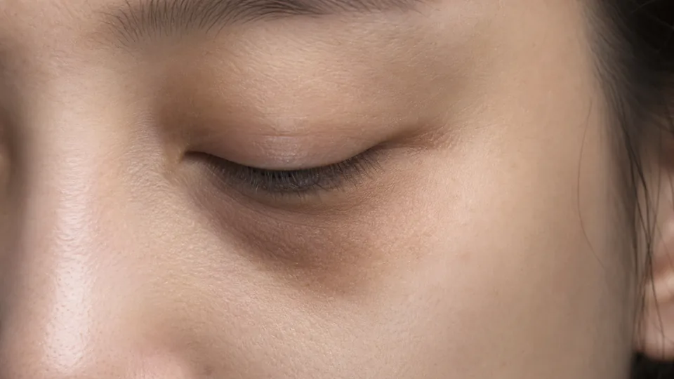 푹 꺼진 눈밑·다크써클 — 고민 카드